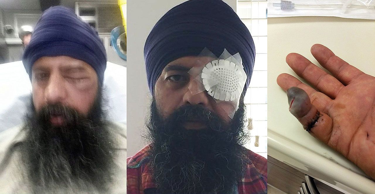 The attack left Khalsa with a swollen black eye, dental damage that will cost more than $2,000 and an infected finger that could be amputated. (Sikh Coalition)