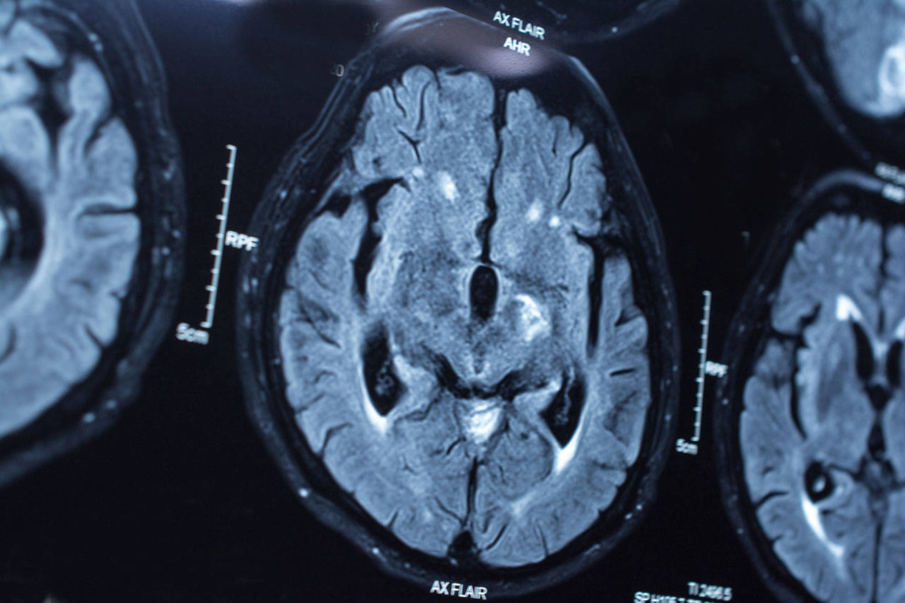 A CT scan of a patient’s brain. (Thinkstock.com)