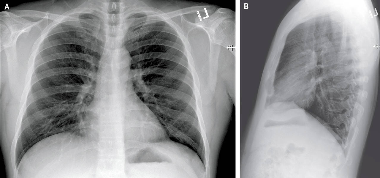 Posteroanterior and Lateral Chest Radiographs, Jan. 19, 2020 (Illness Day 4). No thoracic abnormalities were noted (Snohomish Health District)