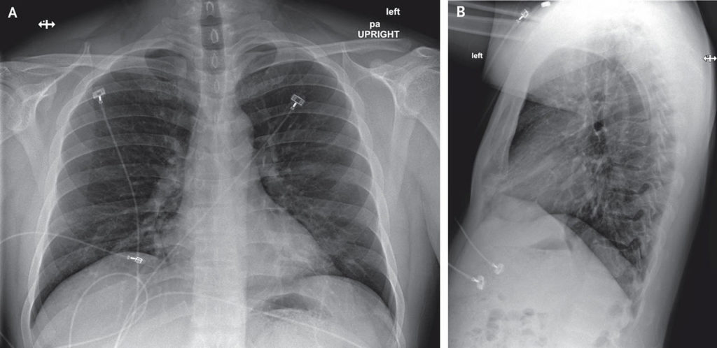 Posteroanterior and Lateral Chest Radiographs, Jan. 22, 2020 (Illness Day 7, Hospital Day 3). No acute intrathoracic plain-film abnormality was noted. (Snohomish Health District)
