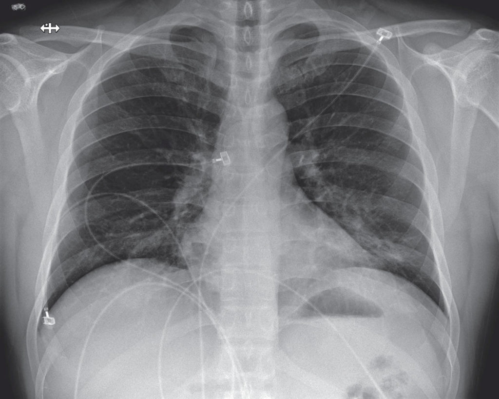 Posteroanterior Chest Radiograph, Jan. 24, 2020 (Illness Day 9, Hospital Day 5). Increasing left basilar opacity was visible, arousing concern about pneumonia. (Snohomish Health District)
