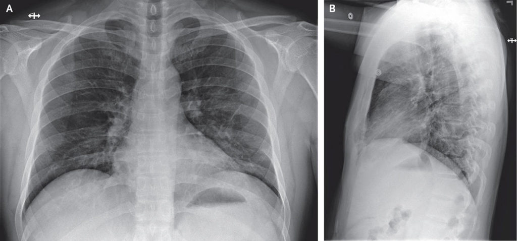 Anteroposterior and Lateral Chest Radiographs, January 26, 2020 (Illness Day 10, Hospital Day 6). Stable streaky opacities in the lung bases were visible, indicating likely atypical pneumonia; the opacities have steadily increased in density over time.
