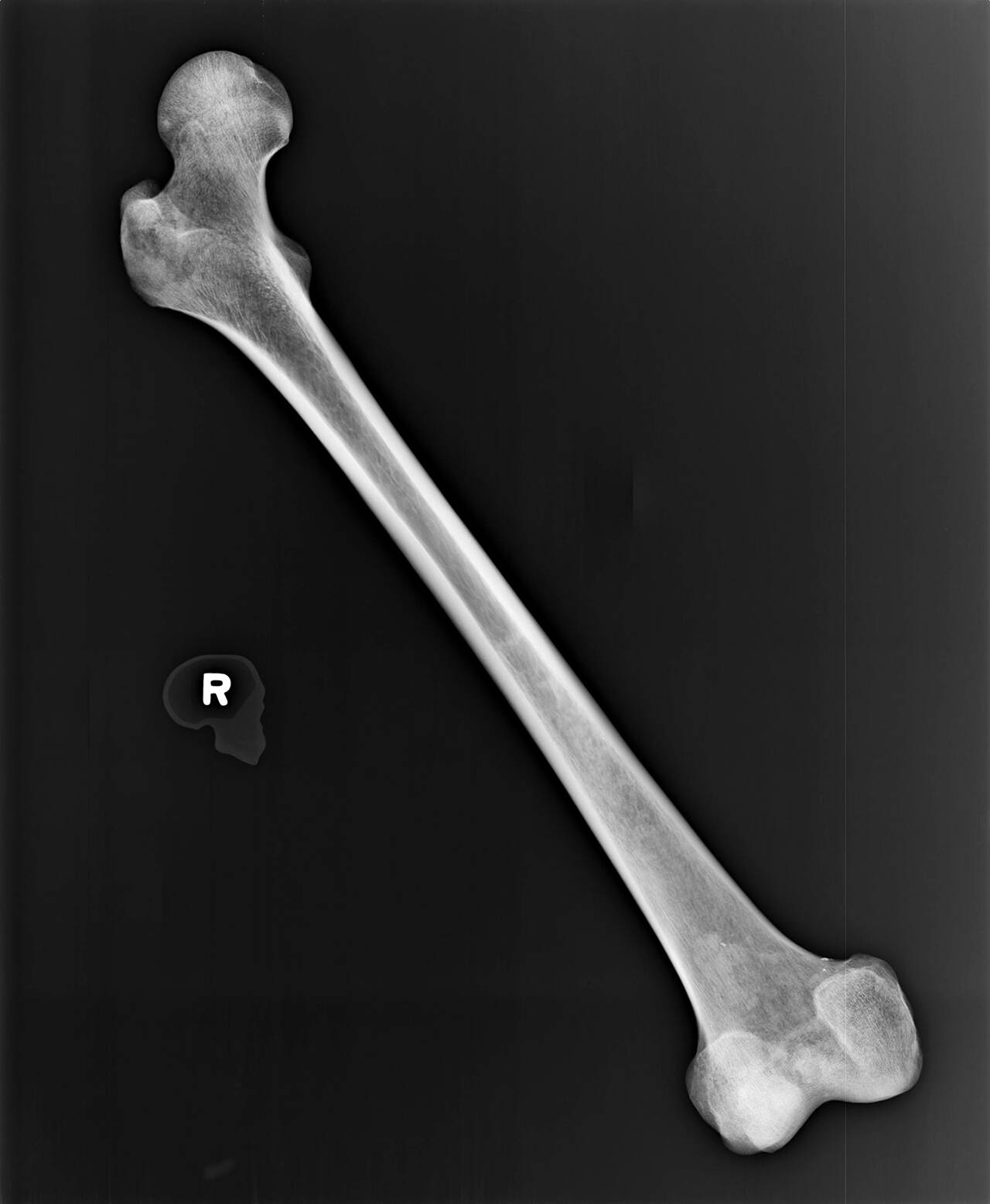 Gary Lee Haynie’s healthy right femur. (Snohomish County Medical Examiner’s Office)