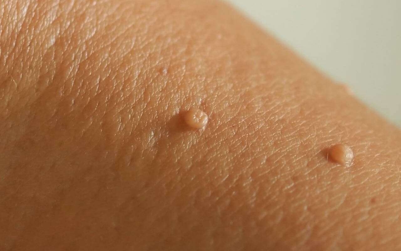 Is Vora Skin Tag Remover Safe for All Skin Types? What You Need to Know