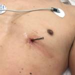 Man drives himself to hospital with nail in his heart