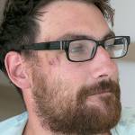 Flash, bang and blood: Hiker tells harrowing lightning tale