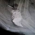 An X-ray shows metallic objects as white areas in a ducks gizzard prior to surgery. (Andy Bronson / The Herald)