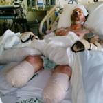 Greg Manteufel suffered sepsis after harmful bacteria from a dogs saliva seeped into his bloodstream. His legs and hands have been amputated. (Dawn Manteufel)