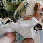 Dog spit causes man’s legs and hands to be amputated