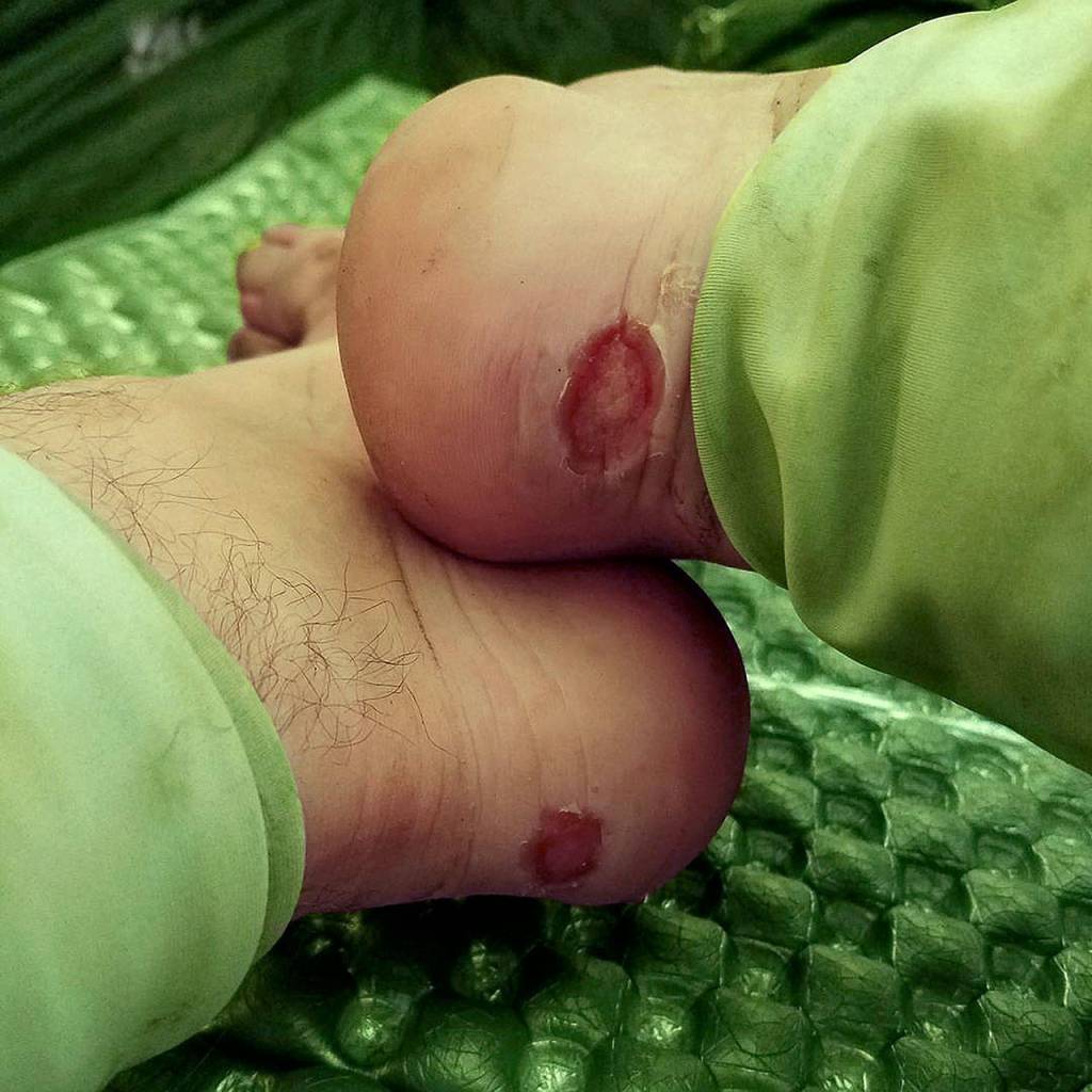 By mile 91, Devin Boyd was suffering from nasty blisters. (Photo Devin Boyd)