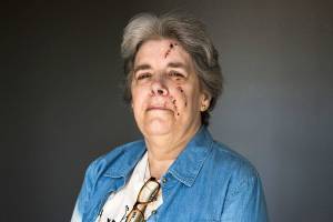 She was mauled by a pit bull, but she’s ‘not mad at the breed’