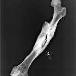 An X-ray shows the broken left femur of a man found dead in mud flats north of Everett in 1979. It had healed in a deformed way, likely leaving him with a pronounced limp. (Snohomish County Medical Examiners Office)