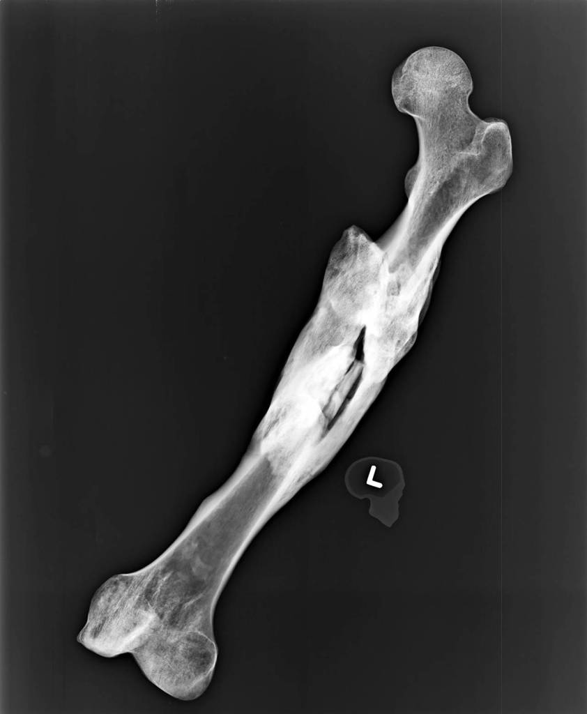 An X-ray shows the broken left femur of a man found dead in mud flats north of Everett in 1979. It had healed in a deformed way, likely leaving him with a pronounced limp. (Snohomish County Medical Examiners Office)