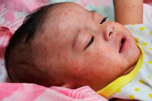 An infant is shown with measles. (Washington State Department of Health/Centers for Disease Control)
