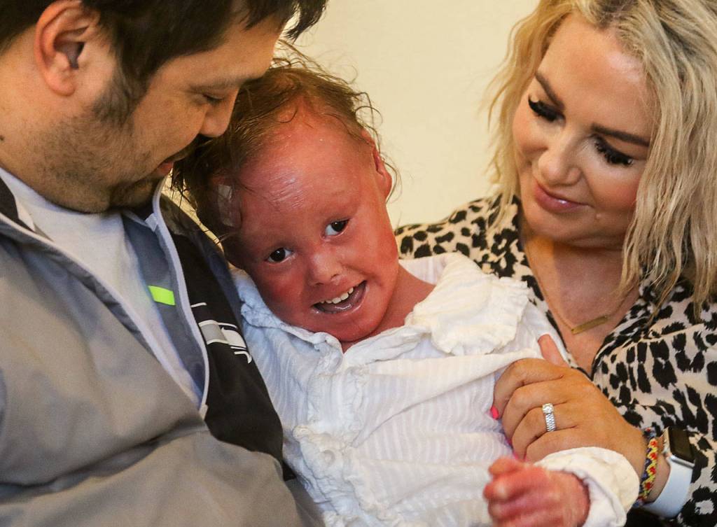 Angie and Kevin Foy had no idea they were carriers of a mutated gene that caused their daughter Harper, 4, to be born with harlequin ichthyosis. The rare condition causes skin to grow thick and scaly. The Edmonds couple care for Harper with frequent baths, ointment and much love. (Dan Bates / The Herald)