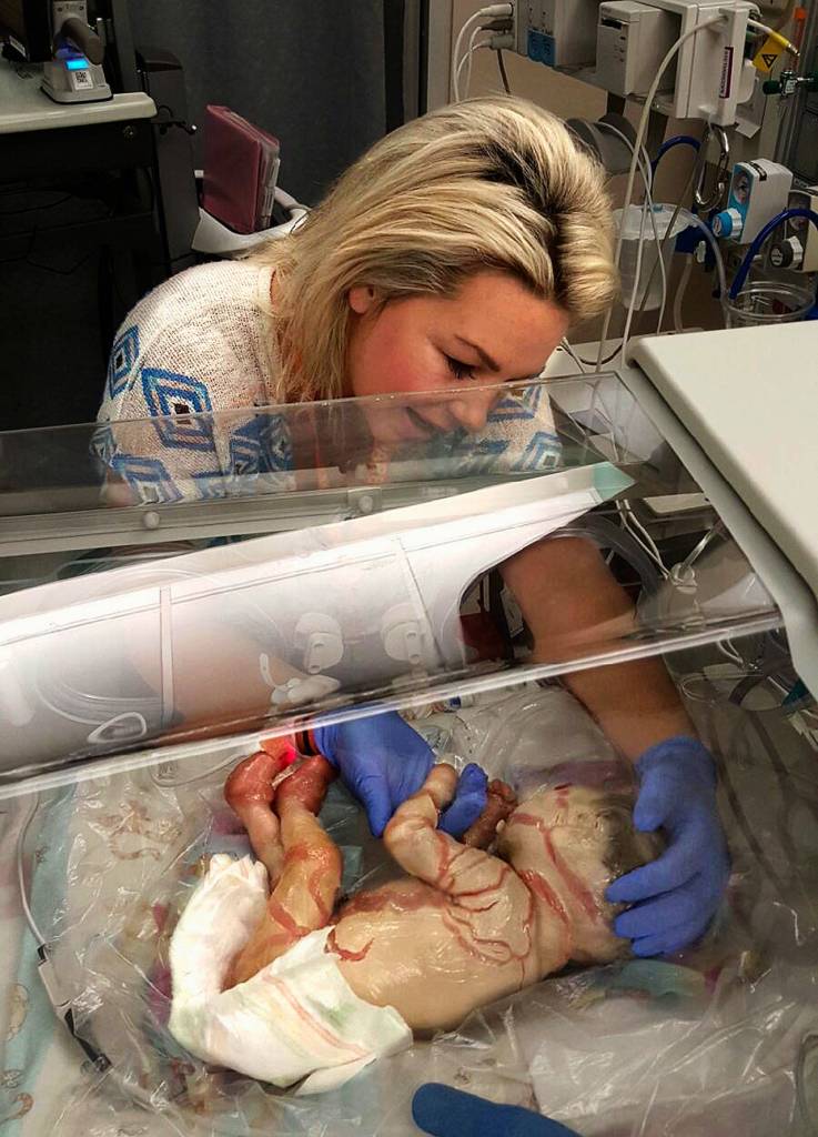 Harper Foy, born Sept. 20, 2015, is comforted by her mother, Angie Foy, shortly after her birth. Harper was born with harlequin ichthyosis, a rare genetic condition in which newborns have hard plates of thickened skin covering their bodies.