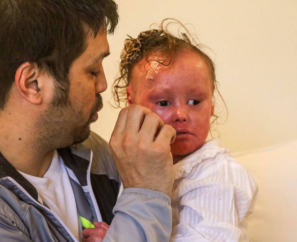 After getting a bump on the head, 4-year-old Harper Foy is calmed down by her dad, Kevin Foy. Born with a rare genetic condition, Harpers skin is paper thin and she bleeds easily. (Dan Bates / The Herald)