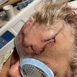 This May 18 photo shows lacerations on Allen Minishs head as he recuperates at a hospital in Anchorage, Alaska, following a mauling by a brown bear. (Courtesy of Allen Minish via AP)