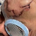 This May 18, 2021, photo, provided by Allen Minish shows lacerations on Minish's head as he recuperates at a hospital in Anchorage, Alaska, following a mauling by a brown bear. The bear charged Minish after a chance encounter in a wooded area near Gulkana, Alaska, and he estimated the encounter lasted less than 10 seconds. (Courtesy of Allen Minish via AP)