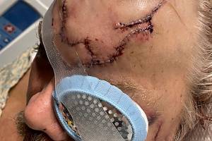 This May 18, 2021, photo, provided by Allen Minish shows lacerations on Minish's head as he recuperates at a hospital in Anchorage, Alaska, following a mauling by a brown bear. The bear charged Minish after a chance encounter in a wooded area near Gulkana, Alaska, and he estimated the encounter lasted less than 10 seconds. (Courtesy of Allen Minish via AP)