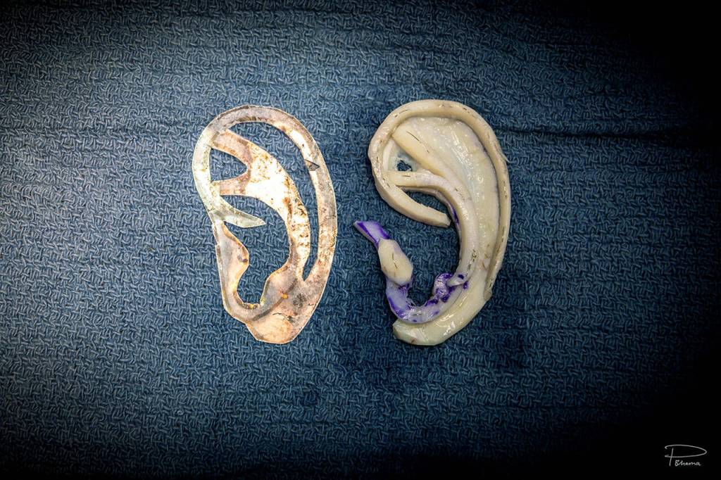 Example of an ear created from cartilage harvested from a patients rib. At left is the template used to create the ear. (HUGS photo)