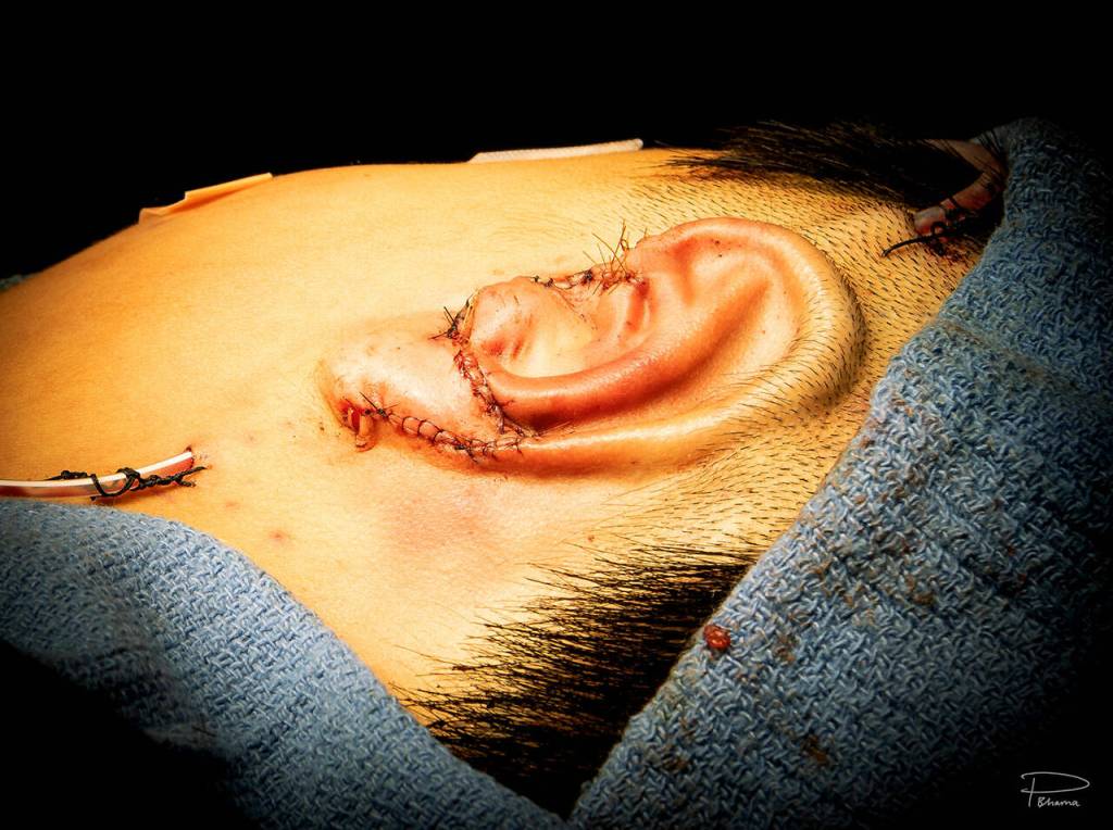 Immediate result following placement of reconstructed ear underneath soft tissue of the scalp. (HUGS photo)