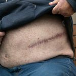 George Beard lifts his shirt to show a massive scar from an abdominal surgery he had a few years ago on Thursday, May 23, 2024, while sitting outside the Stanwood Library in Stanwood, Washington. Between the abdominal surgery and a leg surgery around the same time, Beards health and medical bills have left him living out of his car, unable to work. (Ryan Berry / The Herald)