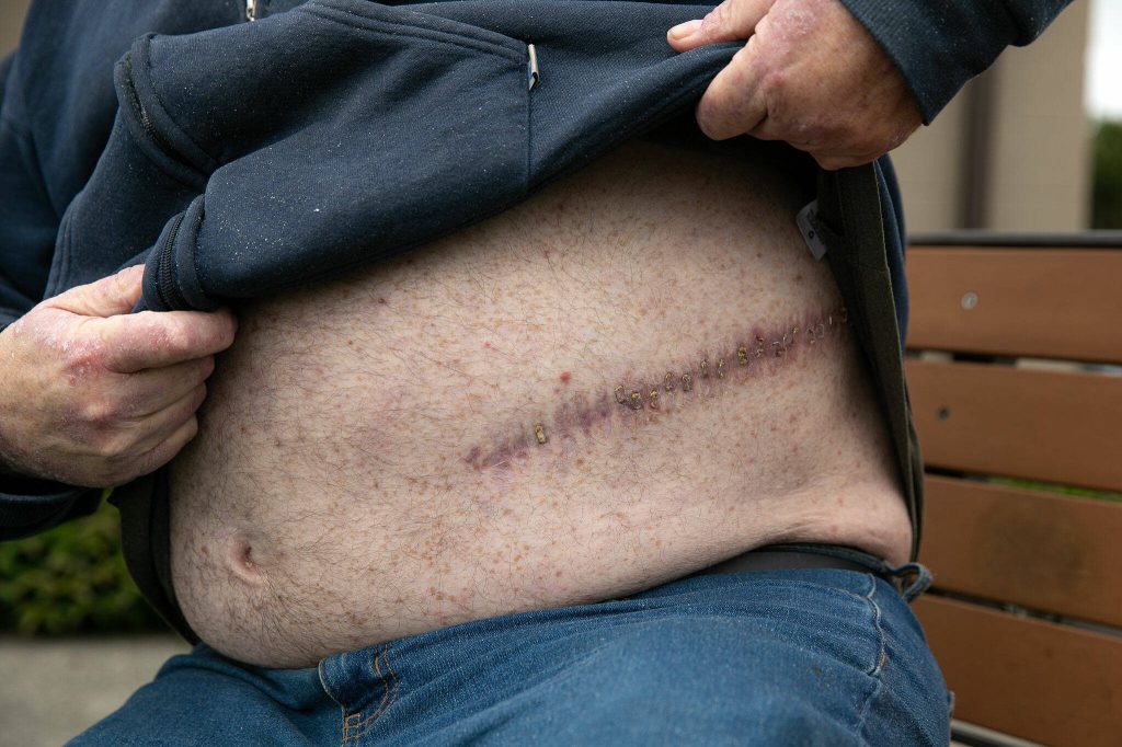 George Beard lifts his shirt to show a massive scar from an abdominal surgery he had a few years ago on May 23 while sitting outside the Stanwood Library. Between the abdominal surgery and a leg surgery around the same time, Beards health and medical bills have left him living out of his car, unable to work. (Ryan Berry / The Herald)