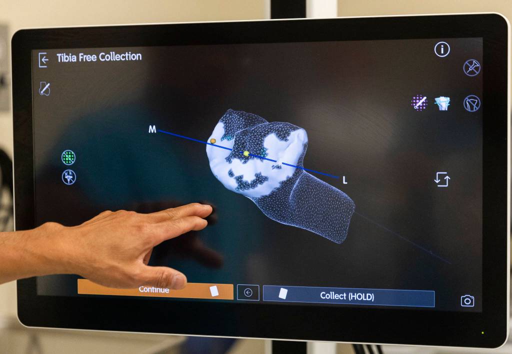 Dr. Bill Huang, an orthopedic surgeon, shows a 3D tibia recreation on Wednesday, Sept. 3, 2025 in Everett, Washington. (Olivia Vanni / The Herald)